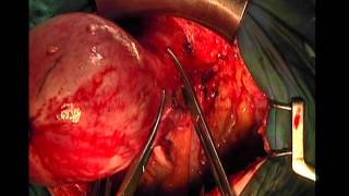 Histerectomía abdominal