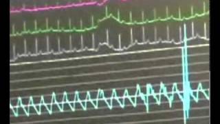 Watch an Angiogram Procedure