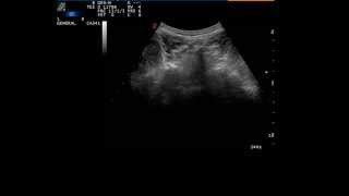 Ultrasound guided  facet joint injection -2 (L5-S1)
