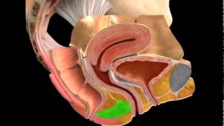 Vaginal prolapse Surgery of posterior wall 3D