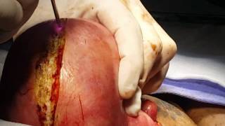 Miomectomia a Laser