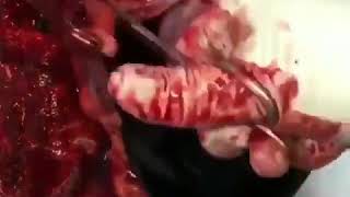 Cardiac Temponade on autopsy