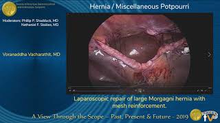 Laparoscopic repair of large Morgagni hernia with mesh reinforcement