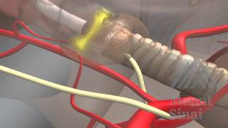 Mount Sinai technique for Endoscopic Transaxillary Thyroidectomy