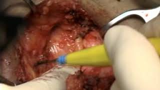 Radical vulvectomy & groin node dissection@CMU