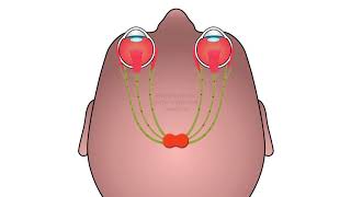 Trigeminal Dysphoria 1min