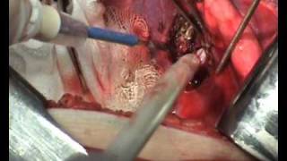 Echinococcosis hidatid cysts of the lungs and the liver