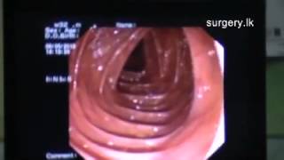 Sigmoidoscopy