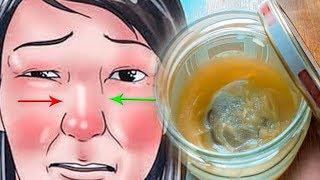 ЭТА МАЗЬ ПОМОЖЕТ ВЫЛЕЧИТЬ ГАЙМОРИТ И ЗАЛОЖЕННОСТЬ НОСА!  БЕЗ ПРОКОЛА...