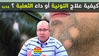 ما هوعلاج تونية أو داء ثعلبة الشعر؟ علاجها بوصفات طبيعية الوقاية منها مع الدكتور عماد ميزاب✔️