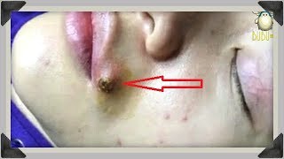INFECTED PIMPLE ON LIP REMOVAL WITH RELAXING MUSIC 130255!
