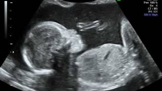 my baby kicking ultrasound