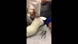 Below-Knee Amputation (BKA) - 1st Follow-Up Post-Op (cast removed)