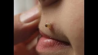Новое выдавливание ПРЫЩЕЙ и ЧЕРНЫХ ТОЧЕК!  p24
