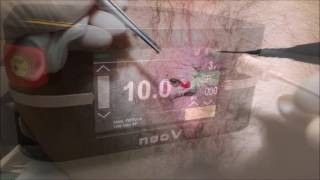 Anal Fistula Laser Treatment with neoV Laser