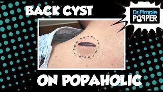 Back Cyst on a Popaholic... baby!