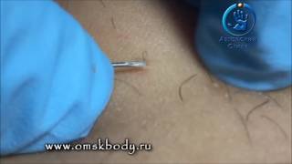 Шугаринг обучение Удаление вросших волос Removing Ingrown Hairs Токмаков