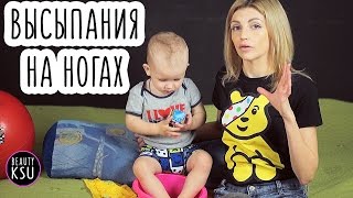 Сыпь и аллергия у малыша. Дерматит. Детские заболевания и их лечение