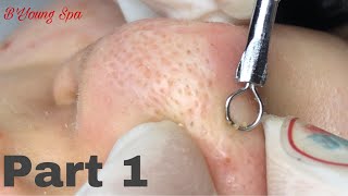 B'Young Spa | PART 1  Remove hidden acne, blackheads