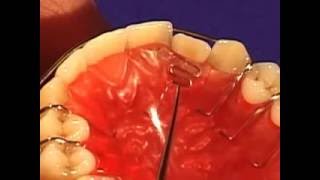Recurve finger spring, Dental Appliance