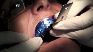 Dentist Training - Single Implant Impression