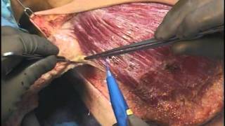 Mastectomía radical (Radical Mastectomy step by step)