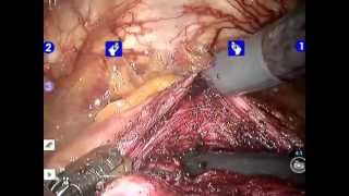 Robot assisted simple prostatetcomy (RASP), performed by Deliu-Victor Matei in Milan