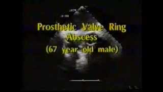 11 - PROSTHETIC  HEART  VALVES  ASSESSMENT