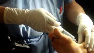 Operación Hallux Valgus (Juanetes), Mínima Invasión 1 de 7