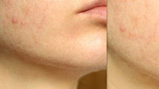 SOS!!ПРЫЩИ, черные точки, ПЯТНА: МОИ МЕТОДЫ