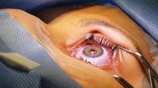 Cirurgia Refrativa LASIK Dra Roberta Campos