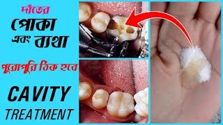 দাঁতের পোকা এবং দাঁতের ব্যথা থেকে চিরতরে মুক্তি পান || Tooth Cavity & Pain Natural Treatment at Home