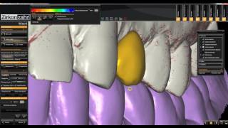 Моделирование полноанатомической коронки по технологии CAD/CAM. ZIRKONZAHN