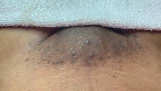 Vajacial (EXTRACTIONS) Hygiene Routine