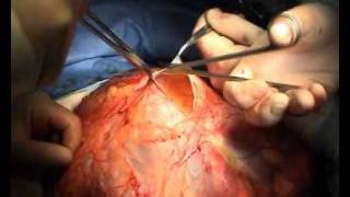Вентральная грижа - Оnlay incisional hernia repair