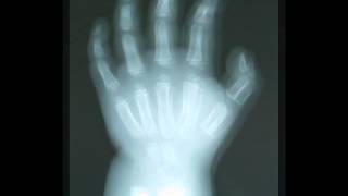 Radiological Case by Ricardo Arenas. Bone Age (1).