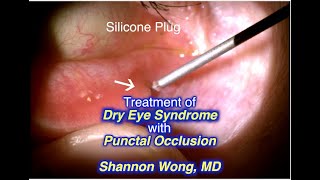 Punctal occlusion for treatment of Dry Eye.  Shannon Wong, MD 11-17-19