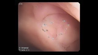 recto-cutaneous fistula.
