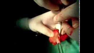 subcapsular orchidectomy