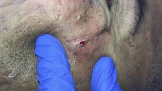 Managing Ethnic skin (extractions part 4)