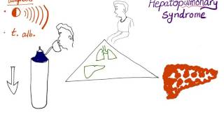 Hepatopulmonary syndrome, the clinical triad!