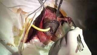 Extensive Fournier's gangrene