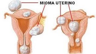O que é Mioma? Tipos e Tratamentos!!!