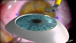 Artiflex toric implantation "Step by Step" by Dr. J. L. Güell