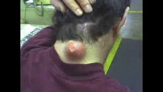 BIGGEST ZIT ON PLANET EARTH!!!!