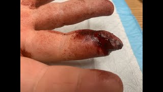Finger Amputation / Repair