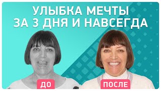 Имплантация зубов all-on-6® на верхней челюсти всего за 3 дня ? Отзыв пациентки Smile-at-Once
