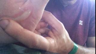 Penis Shaped Blister on palm of hand (As seen on Ridiculousness)