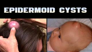 YouTube Hates Spots & Blemishes! Watch the Real Pops!