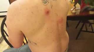Huge Zit Mega Cyst